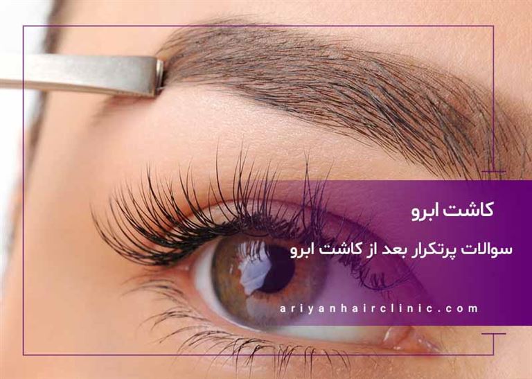 سوالات پرتکرار بعد از کاشت ابرو